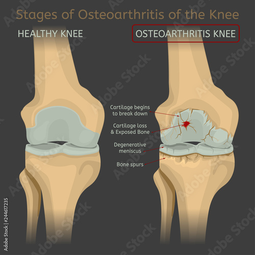 Stages of osteoarthritis of the knee