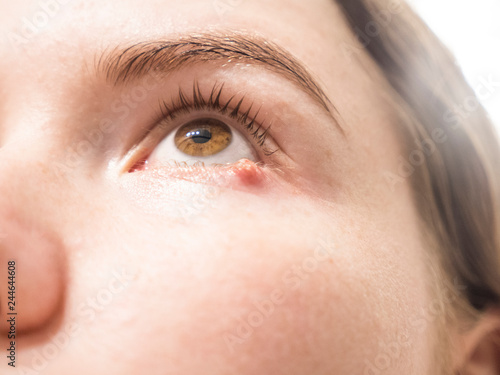Fototapeta Naklejka Na Ścianę i Meble -  Eyelid abscess. Close up photo of young caucasian woman barley brown eye infection, eyelid abscess, stye, hordeolum. Concept of health, disease and treatment.
