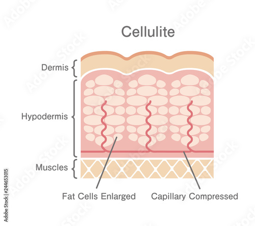 Cellulite's skin illustration 