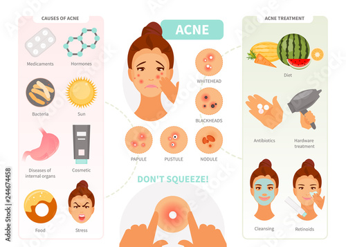 Acne infographic vector