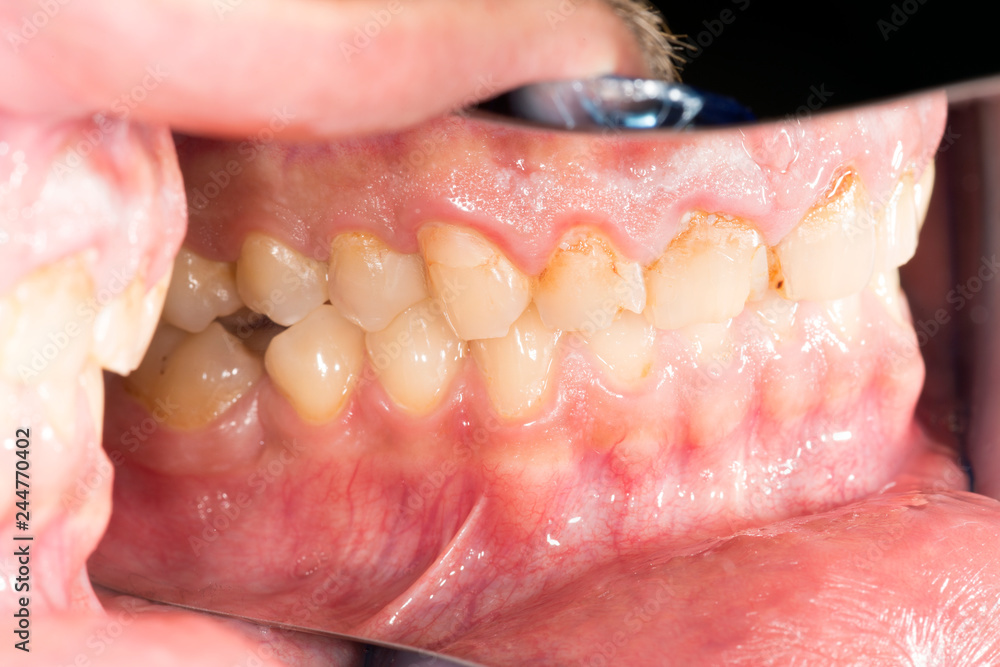 Caries Teeth Decay-Bad Teeth Care And Irregular Oral Hygiene Contribute To Buildup Of Plaque And Tartar On The Teeth