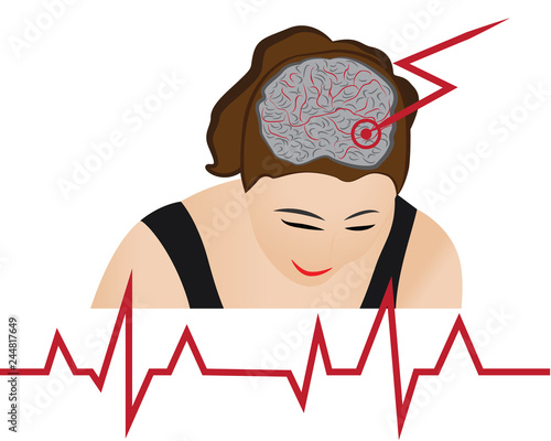 Stroke develope in human brains