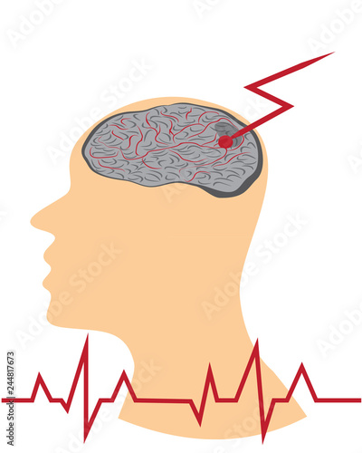 Stroke develope in human brains