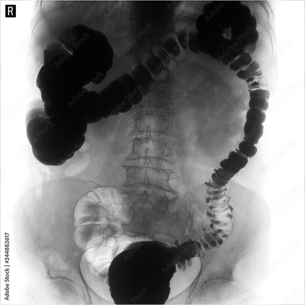 Xray of the lower parts of the gastrointestinal tract (GI). Tight