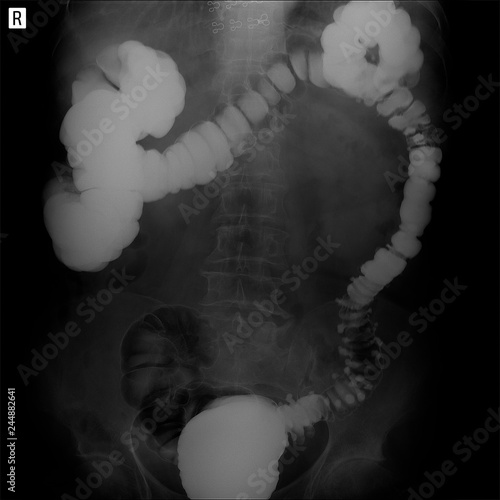 X-ray of the lower parts of the gastrointestinal tract (GI). Tight filling. Dolichocolon. Diverticulosis.  photo