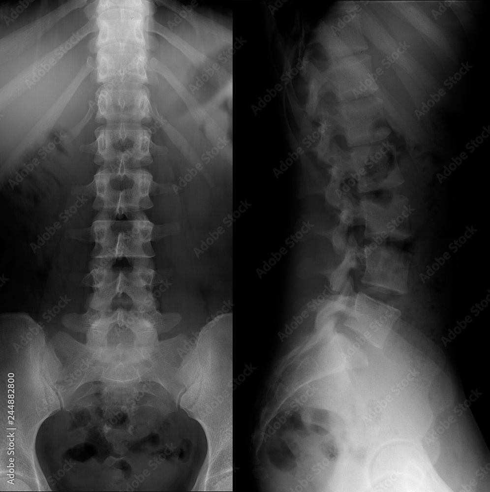 X ray Of The Lumbosacral Spine Normal Perfect Stock Photo Adobe Stock