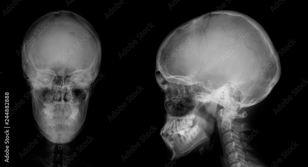 X-ray of the skull. Osteoid-osteoma of the frontal sinus. X-ray of the skull. Osteoid-osteoma of the frontal sinus.