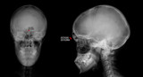 X-ray of the skull. Osteoid-osteoma of the frontal sinus. Marker.