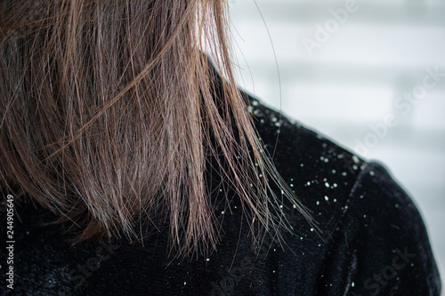  woman hair having problem with dandruff on shoulder  photo