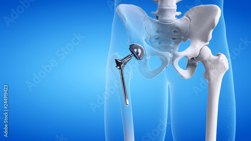 Photography 3d rendered medically accurate illustration of a hip replacement