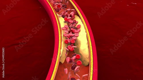 3D rendered Animation of Hemoglobin cells flowing through a clogged Artery developing the illness Arteriosclerosis.
 photo