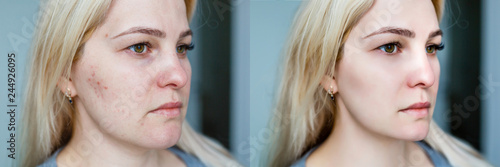 Εκτύπωση καμβά Young woman before and after treatment and make-up.