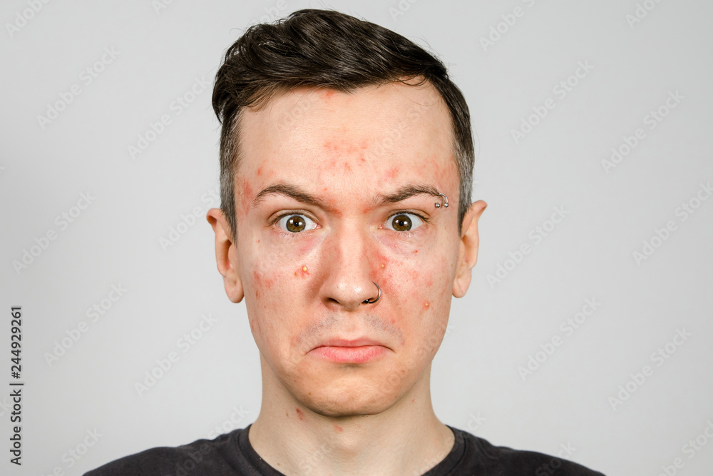teenager with red spots and acne on her face with problem skin acne at a dermologist consultation teenager with red spots and acne on her face with problem skin acne at a dermologist consultation