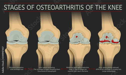 Stages of osteoarthritis of the knee