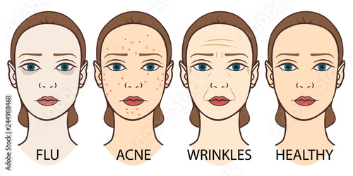 Set of woman faces: pale skin, acne, wrinkles and young healthy skin.  Dermatology, skin care