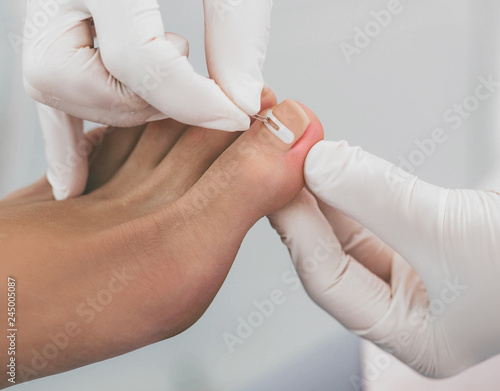 Doctor podiatry treats ingrown nail. onychocryptosis, nail disease photo
