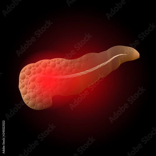 Medical illustration of diseases of the pancreas of a real organ to x-ray effect from lines with a point of inflammation. Pancreatitis