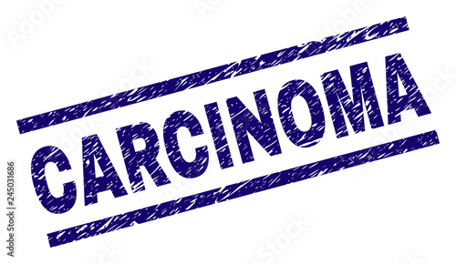 CARCINOMA seal print with scratced style. Blue vector rubber print of CARCINOMA text with unclean texture. Text label is placed between parallel lines.