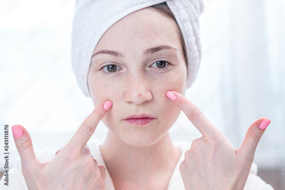 Beautiful unhappy young woman with a towel on her head looking at acne on her face. Hygiene and care for the skin Beautiful unhappy young woman with a towel on her head looking at acne on her face. Hygiene and care for the skin