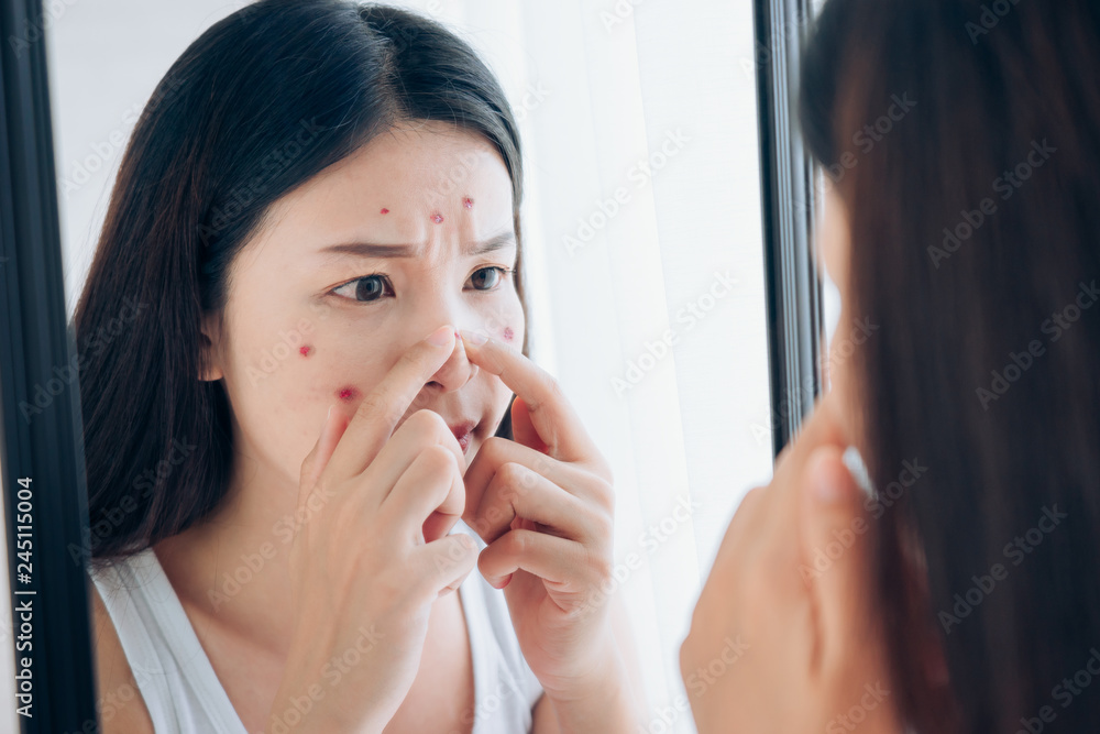 Young Asian woman squeeze acne problem face looking at mirror her without Skincare. Young Asian woman squeeze acne problem face looking at mirror her without Skincare.