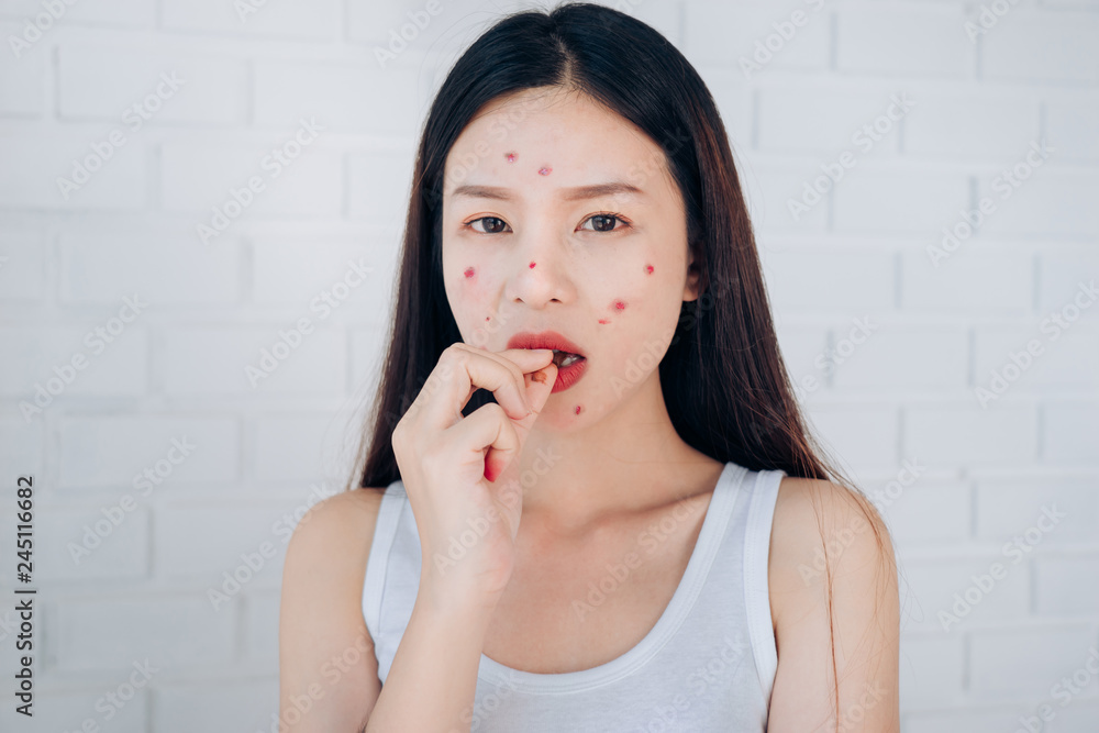 Young Asian woman Acne Problem Face Eating Chocolate bar. Young Asian woman Acne Problem Face Eating Chocolate bar.