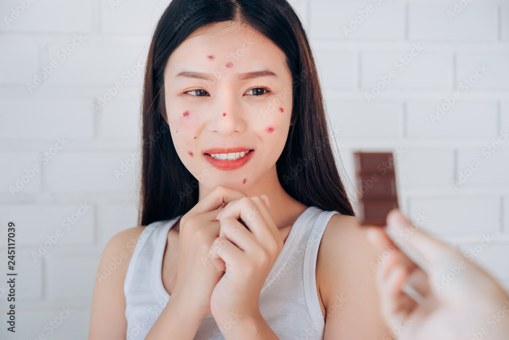 Young Asian Woman Acne Problem Face with Chocolate bar but Happy Eating. Young Asian Woman Acne Problem Face with Chocolate bar but Happy Eating.
