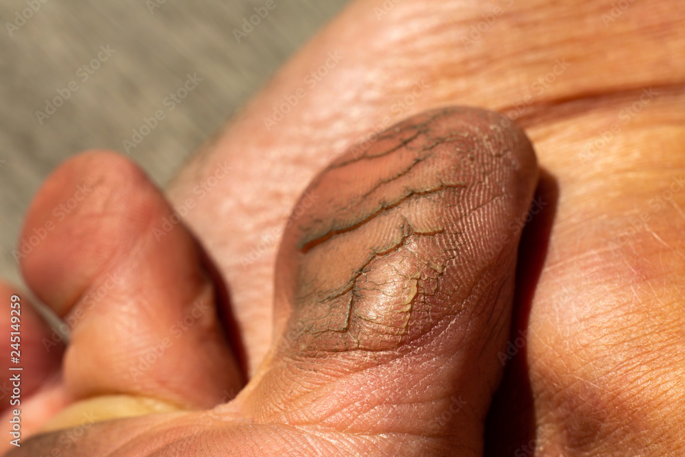 Fototapeta premium Woman's toe break skin on wood, Close up & Macro shot, Selective focus, Asian body skin part, Healthcare concept