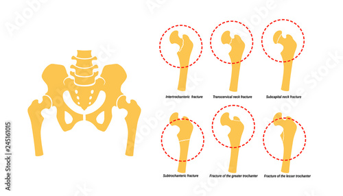 6 Types of Femoral Neck Fracture. Fragment of the structure of the human skeleton. Pelvic girdle and thighs. Silhouette. Sign. Vector.