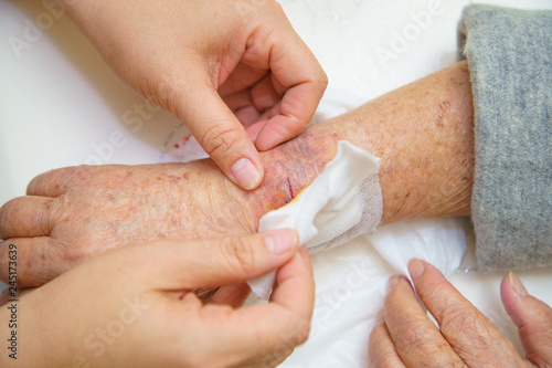 Close up old woman hand, upper limb or arm to the wounded waiting for nurse treatment on wound dressing a bloody and brine of patient.