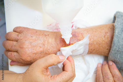 Close up old woman hand, upper limb or arm to the wounded waiting for nurse treatment on wound dressing a bloody and brine of patient.
