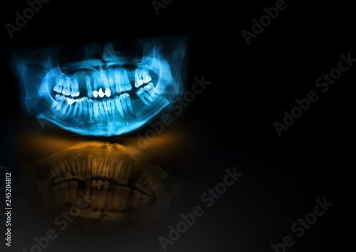 Panoramic radiograph is a scanning dental X-ray of the upper jaw maxilla and lower jawbone mandible. Black background with with glow, shadow and reflection. Medical horizontal design template for text photo