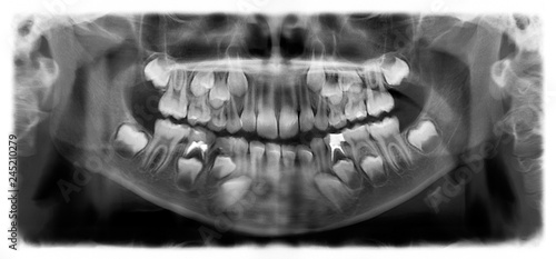 Panoramic radiograph is a scanning dental X-ray of the upper jaw maxilla and lower jawbone mandible. The photo shows a child aged 7 seven years