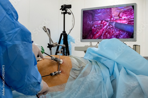 A team of surgeons using endo-instruments operate the patient's abdomen. Endoscopy. Surgery on the body of a complete woman is broadcast online on a monitor or high-definition television. . photo