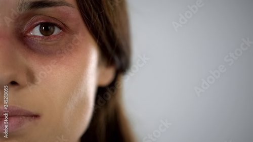Fotografía Sad lady with bruised face looking at camera, violence, gender discrimination