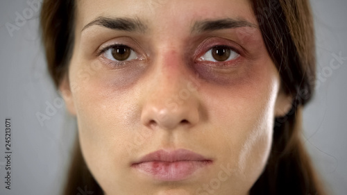 Obraz na plátne Woman with bruise on face sadly looking at camera, victim of assault in family
