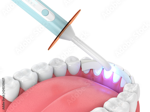 3d render of jaw with dental polymerization lamp and dental fiber photo