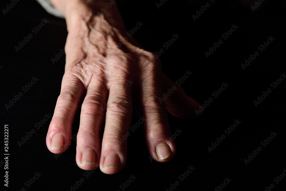 Fototapeta premium finger with rheumatism senior woman