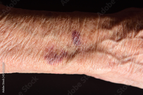 close up of a bruise in the arm of senior woman
