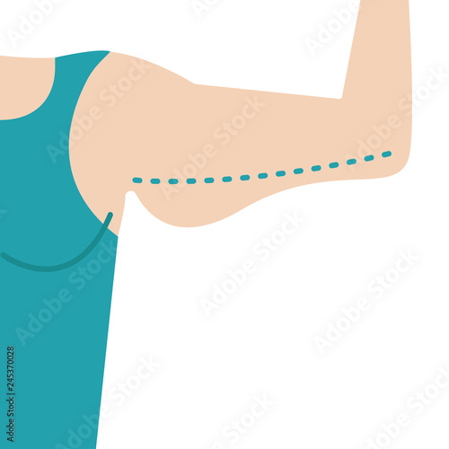Liposuction of arms