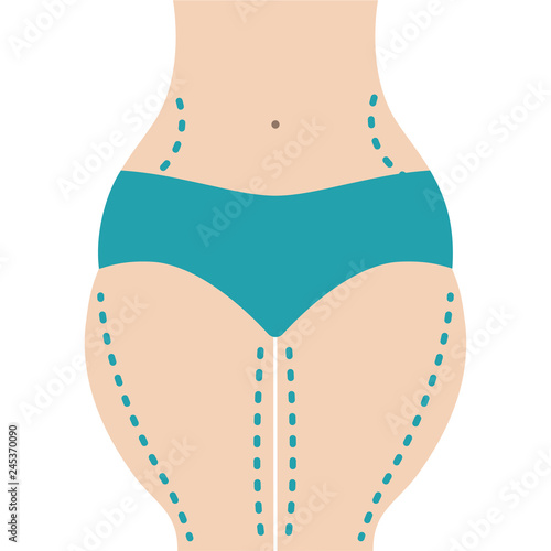 Liposuction of hips and thighs