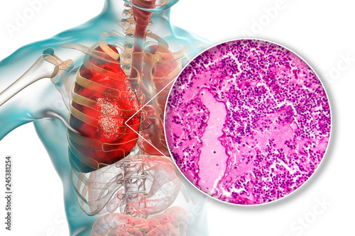 Lobar pneumonia, hemorrhagic edema period, 3D illustration and light micrograph, photo under microscope photo