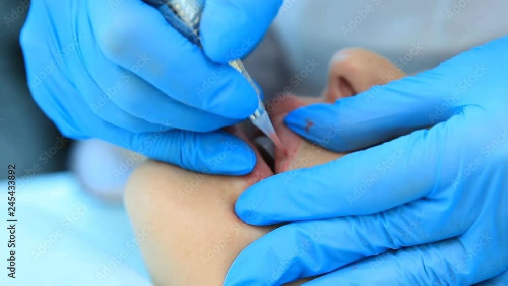 Beautician, applies permanent makeup on eyebrows and lips. Tattoo eyebrows and lips. Applying anesthesia cream before tattooing Beautician, applies permanent makeup on eyebrows and lips. Tattoo eyebrows and lips. Applying anesthesia cream before tattooing