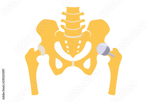 Hip replacement partly half. Vector illustration. Isolated on white background
