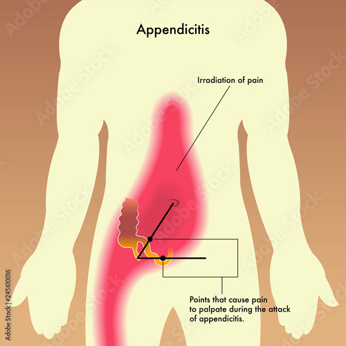 medical illustration showing the points that cause pain to palpate during the attack of appendicitis.