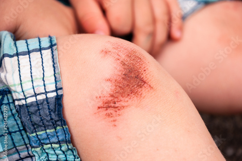 Kind verletzt sich am Knie, Aufschürfung