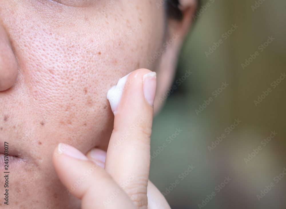 Dark Spots: Causes, Types, and Effective Solutions