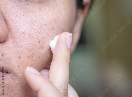 Woman applying cream onto face that has problem problematic skin , acne scars ,oily skin and pore, dark spots and blackhead and whitehead on the face.