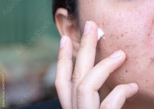 Woman applying cream onto face that has problem problematic skin , acne scars ,oily skin and pore, dark spots and blackhead and whitehead on the face.