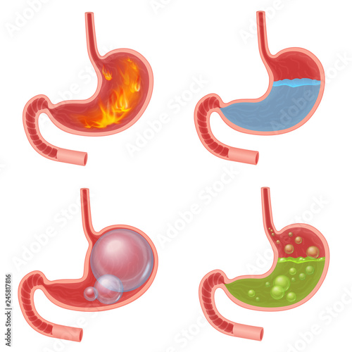 Vector Realistic Stomach medical vector illustration set. Pyrosis fire disorder, gastric acid reflux, Abdominal bloated ball, green liquid nausea.