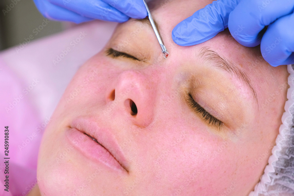Mechanical cleaning of the face at the beautician. Cosmetologist squeeze the acne on the face of the patient medical needle.